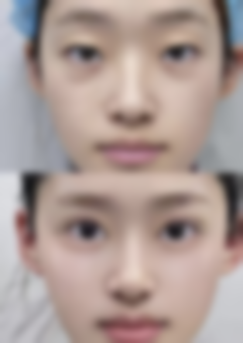 打保妥适瘦脸针有啥优势？了解注射原理