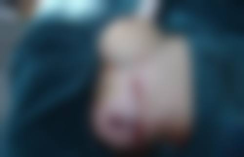 眼袋手术安心吗？多元术式，各显神通