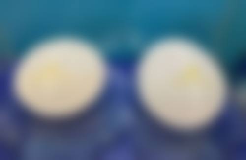 内切外切联合术，术后加速消肿的护理要点