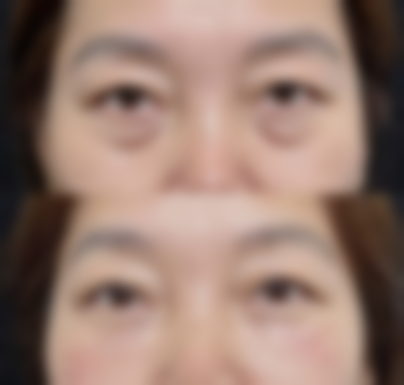 想找自然隆胸办法？自体脂肪隆胸成效棒