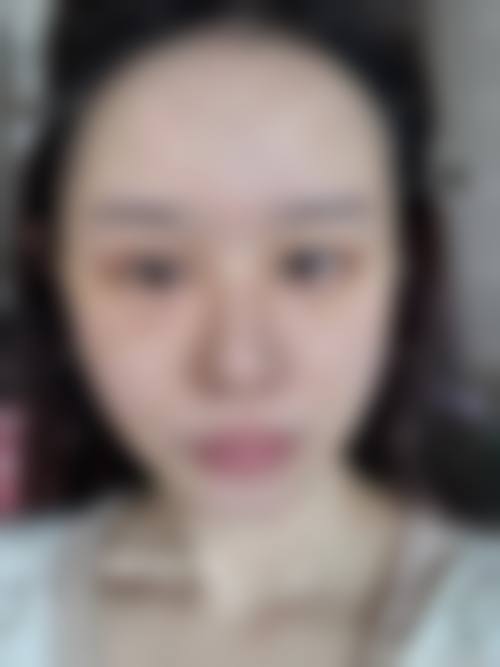 五、抚顺美神整形医院实例