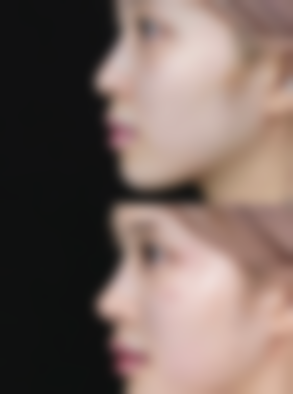 肚子抽脂优势总结：重塑自信人生