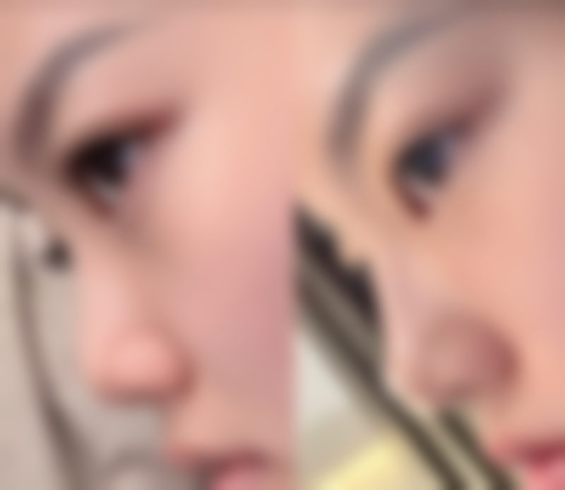 隆鼻子能否保持一辈子？总结与建议