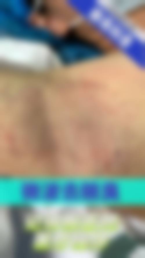 四、山西黄河医院腋臭整形科实例