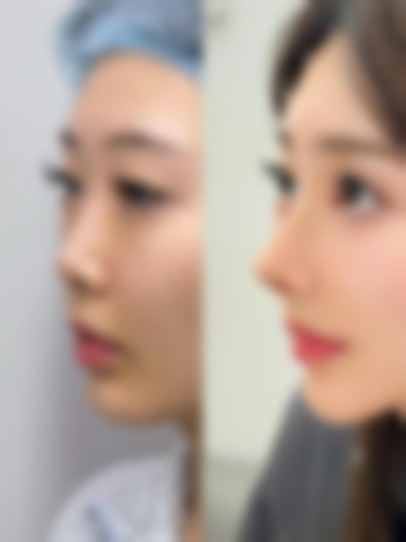 全切双眼皮究竟成效能维持多久？持久魅力，美眸相伴多年
