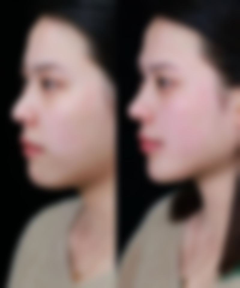 如何控制假体隆胸风险，畅享变得更美体验？