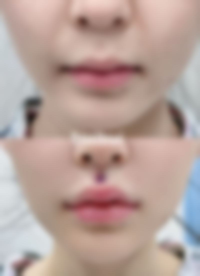 脸上黑色疤痕去除有妙招？蜂蜜滋养，温和淡化疤痕