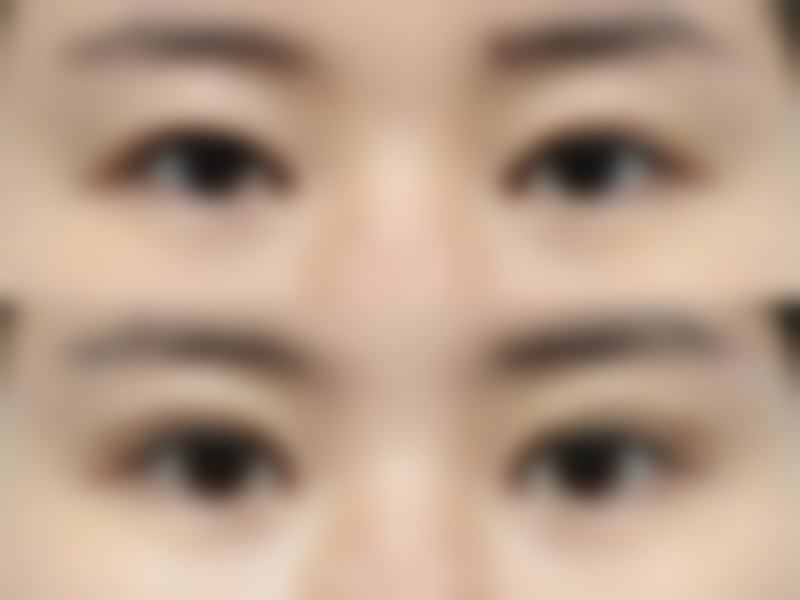 为何会出现一只单眼皮一只双眼皮？——日常护理与注意事项