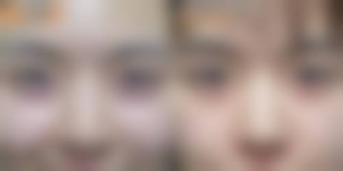 吸脂全麻对身体危害知多少？——术中保护与应对措施