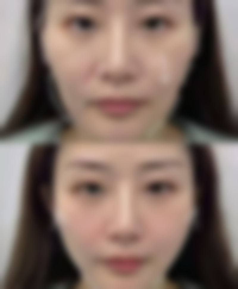 面部疤痕怎么改善？简易辅助护理有办法