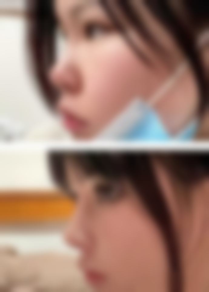 五、温州云谣伊佰丽整形医院实例