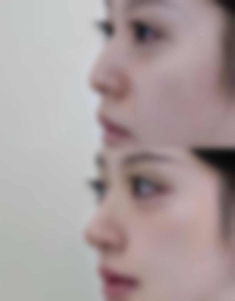 隆鼻的好处知多少?改善呼吸,健康加分