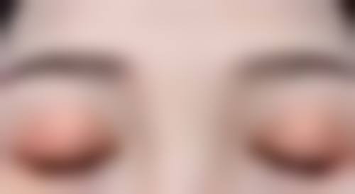 做了双眼皮后疤痕增生,日常护理不能少