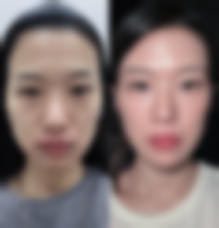 割双眼皮后能否同房?个体差异影响修复