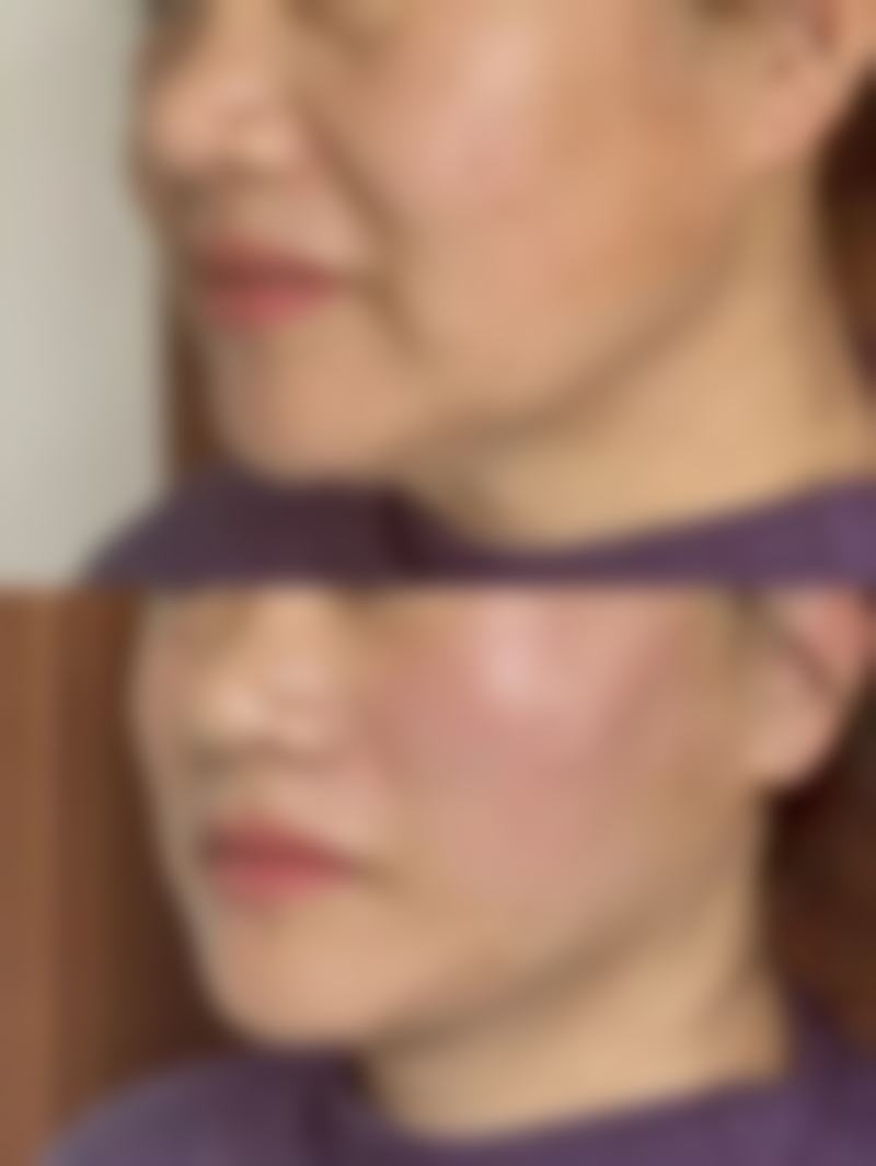 割双眼皮后能否同房?安心修复有保护