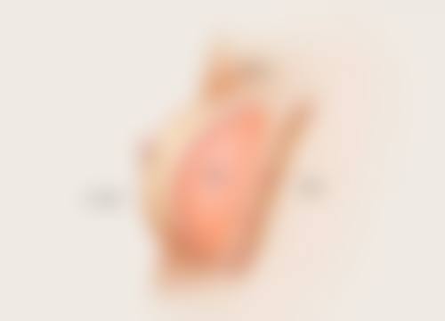 双眼皮拆线后眼角小包别忧!全切双眼皮专属处理有妙招