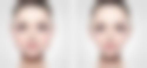 隆鼻是否留后遗症存疑?知晓不同隆鼻方式特有风险