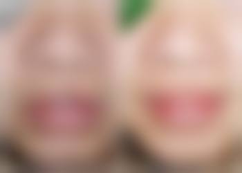 双眼皮做窄了如何补救?常见的修复方法