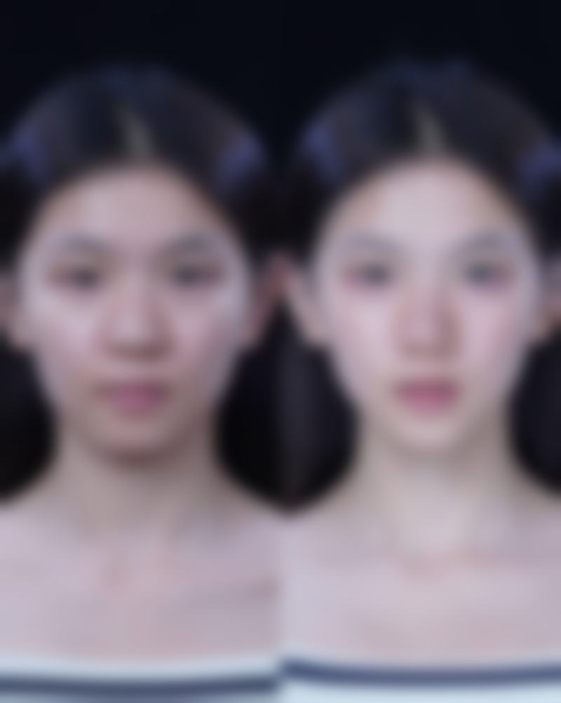隆胸取出假体后，咋改善修复形态？