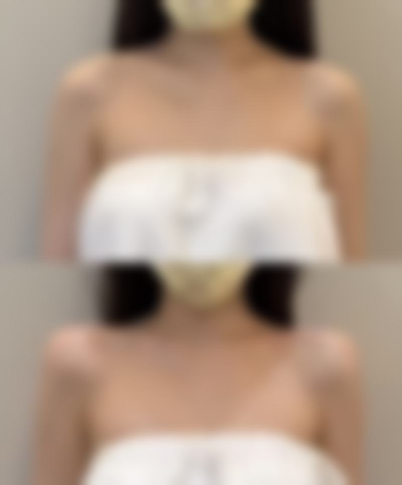 割双眼皮和开眼角会有后遗症吗？了解诱因与应对方法，畅享美丽无忧变美之旅