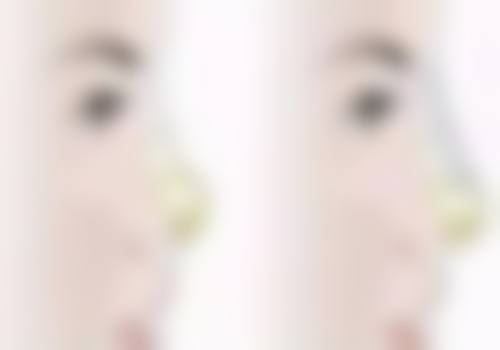 面部疤痕如何淡化?日常护理不可少