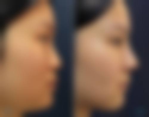 五、韩国Hansarang女性整形医院实例: