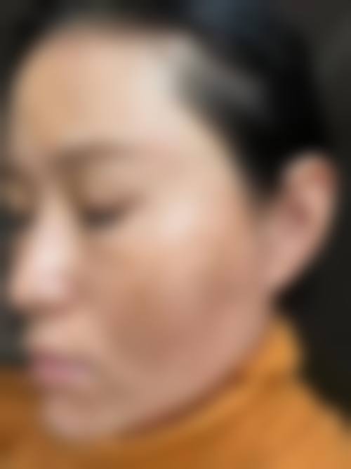 五、柳州华 山医院臻潼彦医疗美容诊所实例：