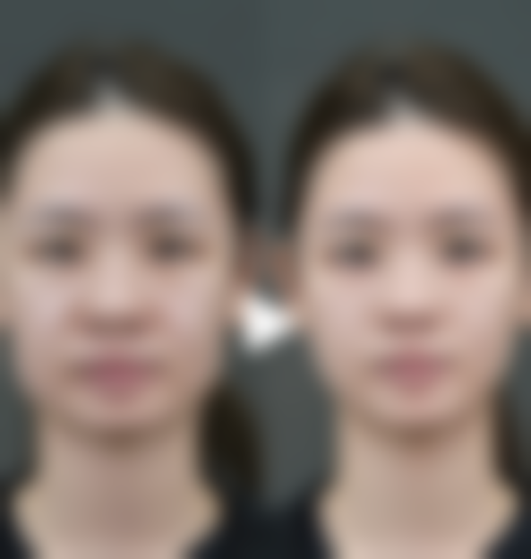 激光祛疤成效究竟行不行？不同面积疤痕的治疗情况