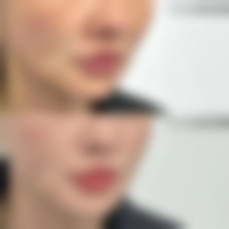 五、菏泽美莱整形医院实例
