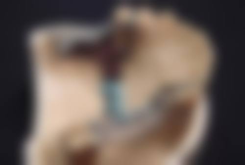 眼角膜疤痕分类:了解不同类型的疤痕