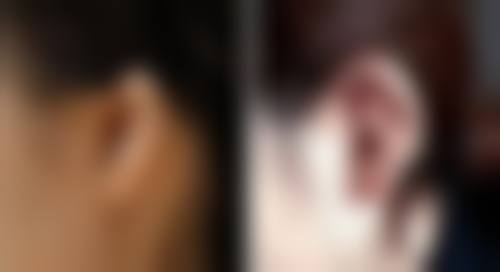 刚出生能割双眼皮吗？了解手术条件、年龄建议与特殊医疗场景需求很关键 