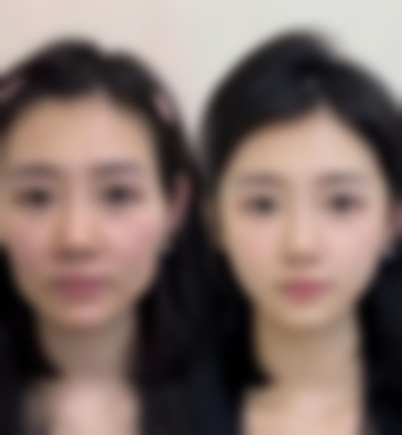 刚出生能割双眼皮吗?儿童割双眼皮的年龄建议