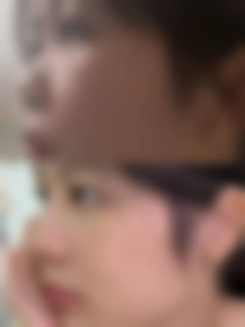 五、天津从业多年刘强整形医院实例