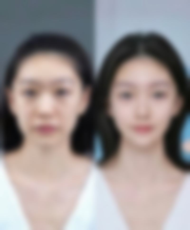 疤痕增生能否修复?了解修复周期参考
