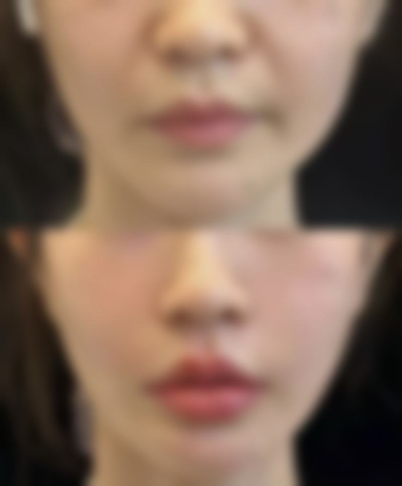阴道紧缩手术好处多:临床成效显著