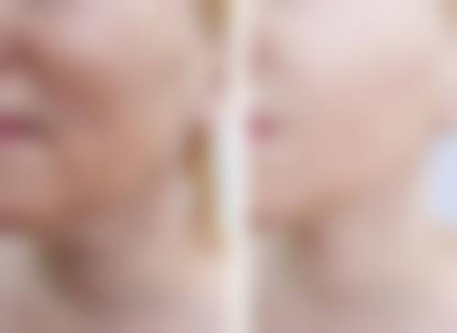 抽脂填胸可能带来啥麻烦？胸部不对称风险及调整办法