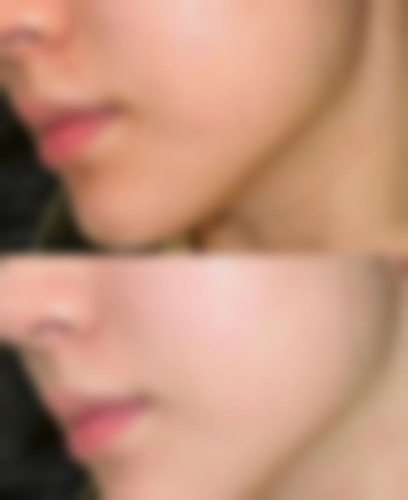 哪些因素影响锁骨骨折手术疤痕修复时间