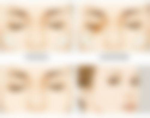 双眼皮没做好啥样？瘢痕明显问题大揭秘