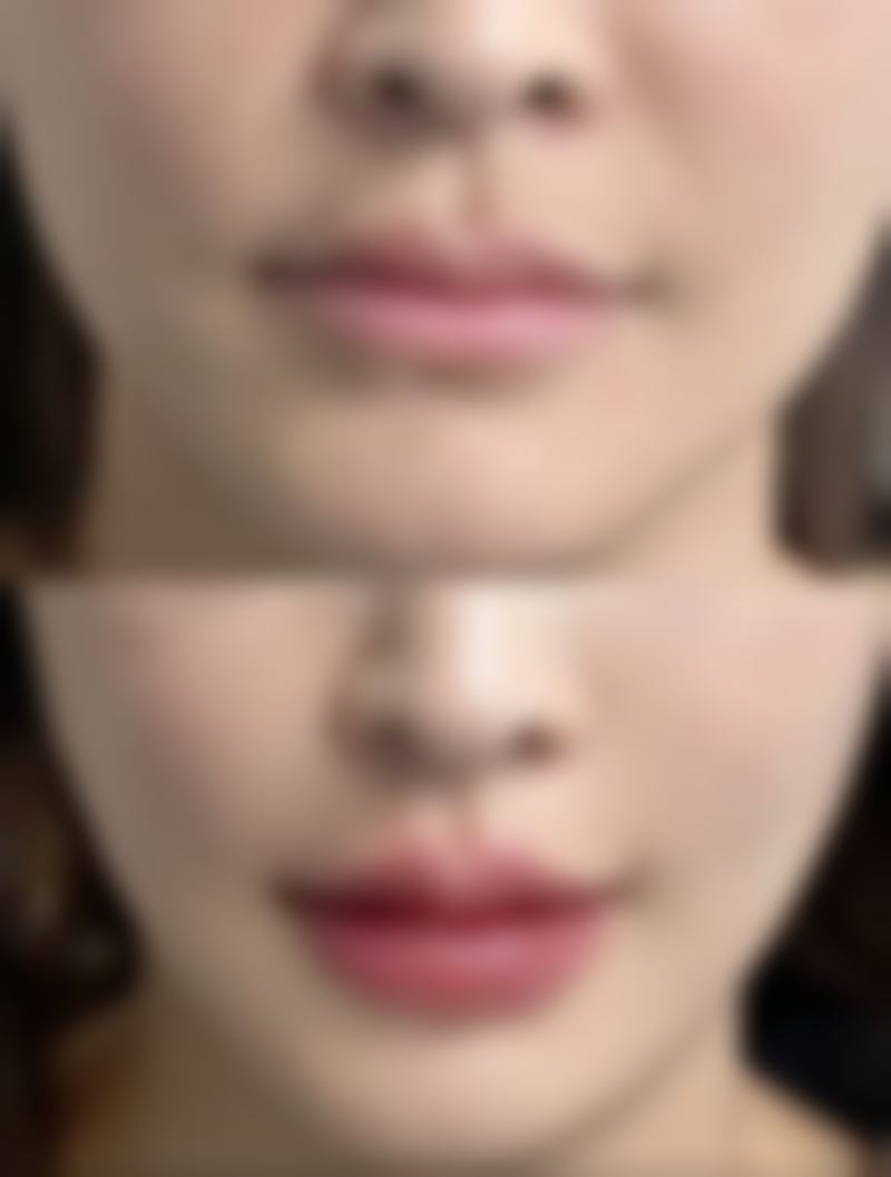 脸部划伤疤痕究竟多久消失？深度、体质、护理揭秘恢复周期与改善妙招 