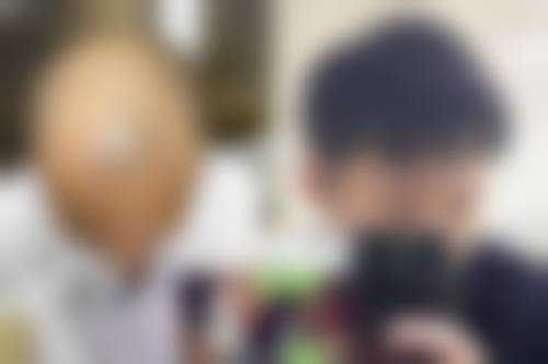 五、青岛大麦植发医院(原科发源)实例