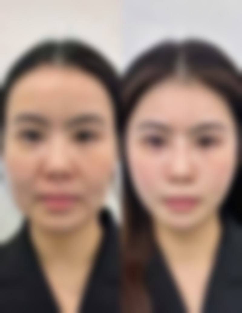 黑眼圈眼袋大究竟为何？揭秘遗传、作息、疾病等多因素引发的眼部困扰