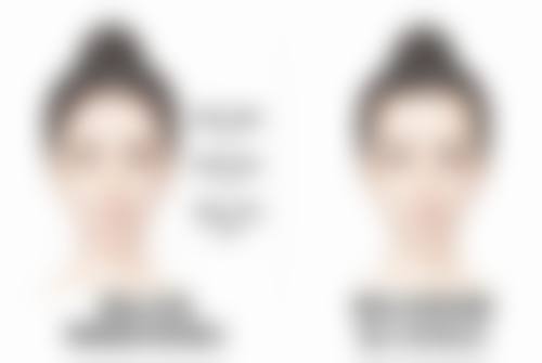 内双割双眼皮:术前注意事项不能忘