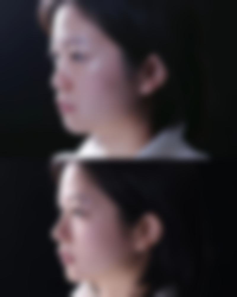 内双也能割双眼皮？多种术式可选，定制个性方案，助你拥有明显重睑形态 
