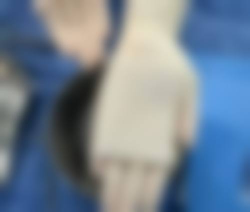 隆胸后遗症知多少：假体隆胸长期特殊后遗症探秘