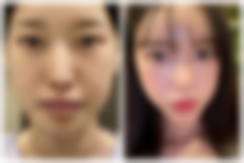 割双眼皮的成效如何？美丽蜕变看得见