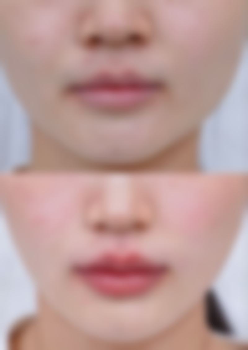 发际线种植维持时间受个人体质影响几何？