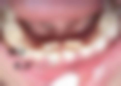 全切双眼皮补针开刀争议总结与建议