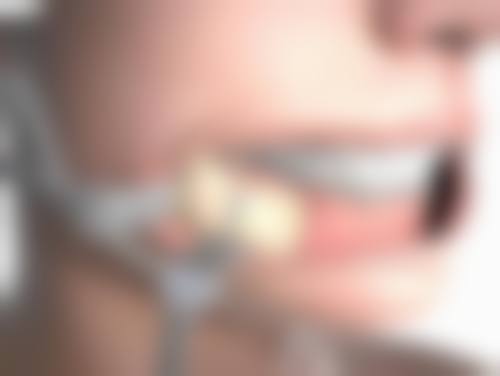 腿部抽脂到底有无危害？深度剖析腿部抽脂危害真相及预防要点 