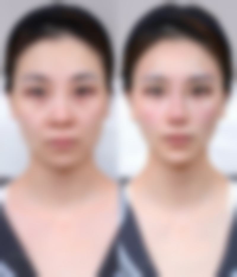 四、韩国真下知外科整形实例