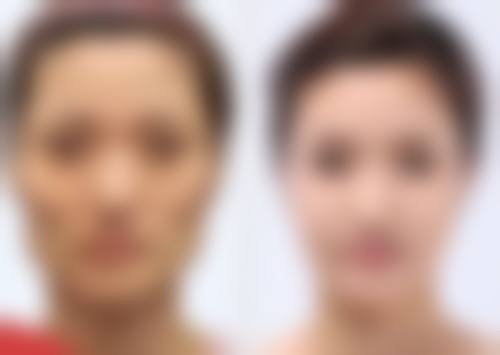 骨粉隆鼻取出前后怎么护理?注意要点不能少